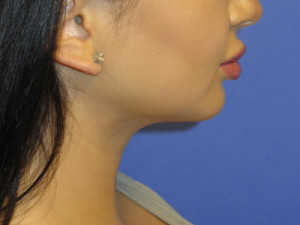 Chin Implant Case 5065 After Photo Chin Implant