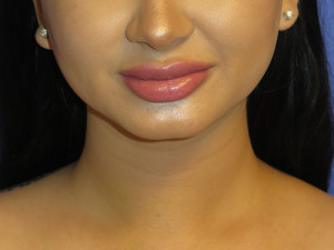 Chin Implant Case 5065 After Photo Chin Implant