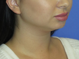 Chin Implant Case 5065 Before Photo Chin Implant