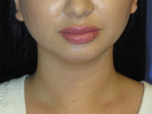 Chin Implant Case 5065 Before Photo Chin Implant