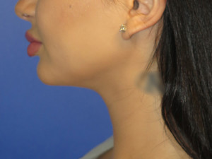 Chin Implant Case 5065 After Photo Chin Implant