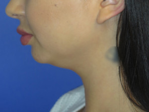 Chin Implant Case 5065 Before Photo Chin Implant