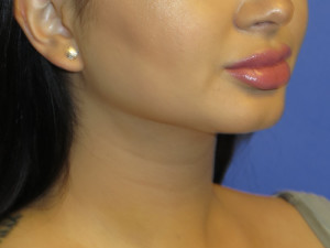 Chin Implant Case 5065 After Photo Chin Implant
