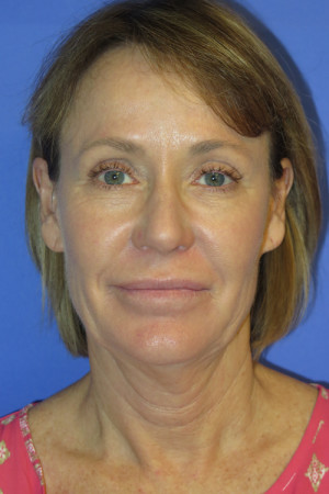 FACEology Lift / Neck Lift Case 5086 Before Photo FACEology Lift / Neck Lift