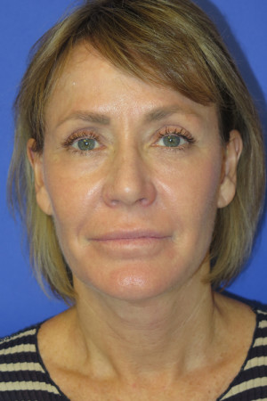 FACEology Lift / Neck Lift Case 5086 After Photo FACEology Lift / Neck Lift