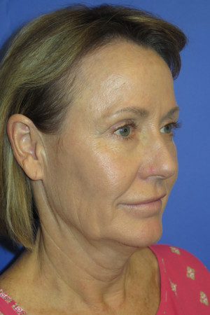 FACEology Lift / Neck Lift Case 5086 Before Photo FACEology Lift / Neck Lift
