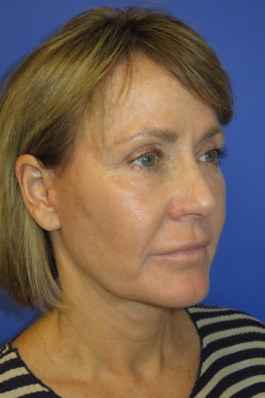 FACEology Lift / Neck Lift Case 5086 After Photo FACEology Lift / Neck Lift