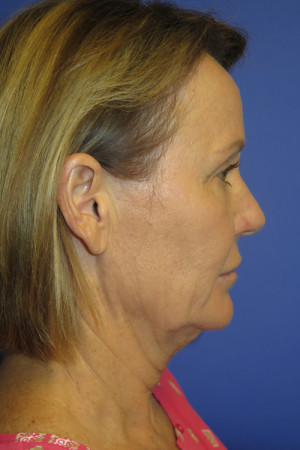 FACEology Lift / Neck Lift Case 5086 Before Photo FACEology Lift / Neck Lift