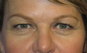 Eyelid Lift Case 5077 Before Photo Eyelid Lift