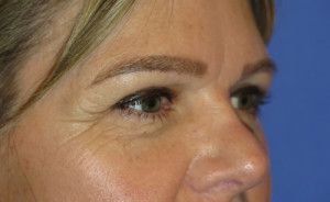 Eyelid Lift Case 5077 After Photo Eyelid Lift