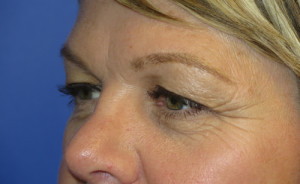 Eyelid Lift Case 5077 Before Photo Eyelid Lift