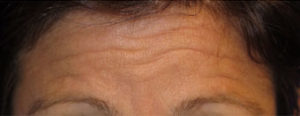 Botox Case 6234 Before Photo Botox