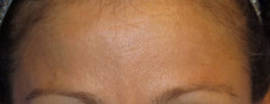Botox Case 6234 After Photo Botox