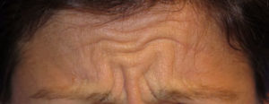 Botox Case 6234 Before Photo Botox