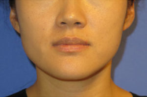 Botox Case 6242 Before Photo Botox