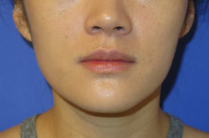 Botox Case 6242 After Photo Botox