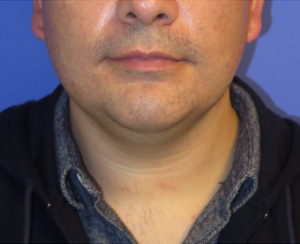 Chin Implant Case 5423 Before Photo Chin Implant