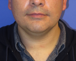 Chin Implant