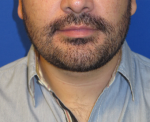 Chin Implant Case 5423 After Photo Chin Implant