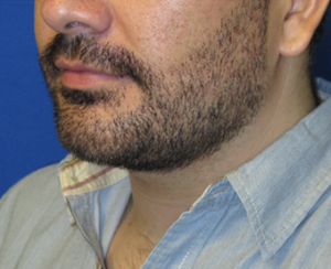 Chin Implant Case 5423 After Photo Chin Implant