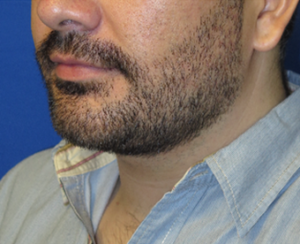 Chin Implant