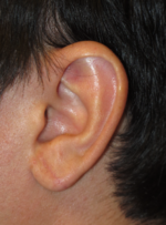 Ear Surgery
