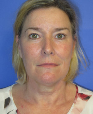 FACEology Lift / Neck Lift Case 5658 Before Photo FACEology Lift / Neck Lift