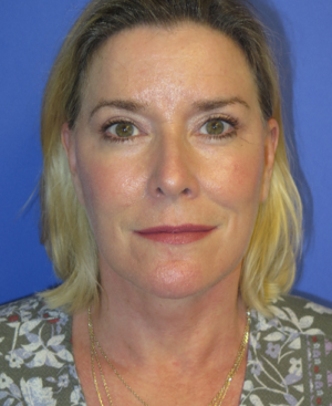 FACEology Lift / Neck Lift Case 5658 After Photo FACEology Lift / Neck Lift