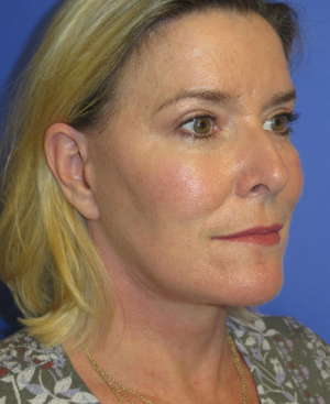 FACEology Lift / Neck Lift Case 5658 After Photo FACEology Lift / Neck Lift