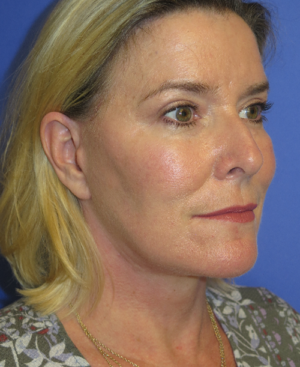 FACEology Lift / Neck Lift