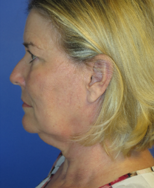 FACEology Lift / Neck Lift Case 5658 Before Photo FACEology Lift / Neck Lift