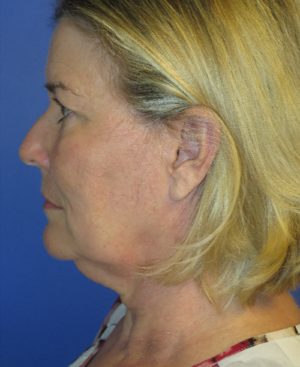 FACEology Lift / Neck Lift