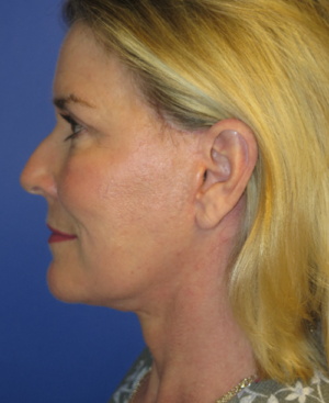 FACEology Lift / Neck Lift Case 5658 After Photo FACEology Lift / Neck Lift