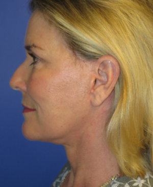 FACEology Lift / Neck Lift