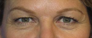 Eyelid Lift Case 5515 Before Photo Eyelid Lift
