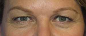 Eyelid Lift