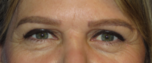 Eyelid Lift Case 5515 After Photo Eyelid Lift