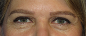 Eyelid Lift