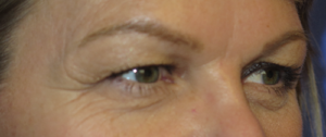 Eyelid Lift Case 5515 Before Photo Eyelid Lift