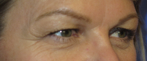 Eyelid Lift