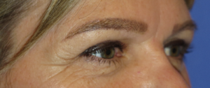 Eyelid Lift Case 5515 After Photo Eyelid Lift