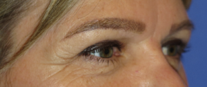 Eyelid Lift