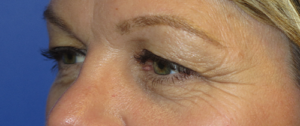 Eyelid Lift Case 5515 Before Photo Eyelid Lift