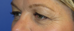 Eyelid Lift