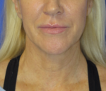 FACEology Lift / Neck Lift