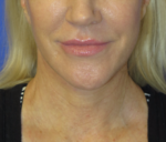 FACEology Lift / Neck Lift