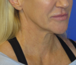 FACEology Lift / Neck Lift