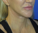 FACEology Lift / Neck Lift