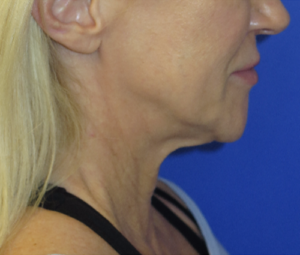 FACEology Lift / Neck Lift