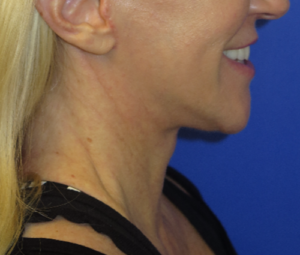 FACEology Lift / Neck Lift